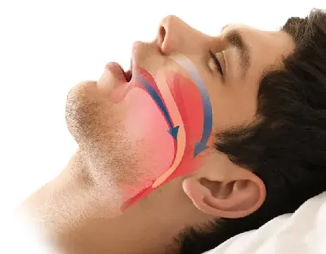 Illustration of the upper airway showing the nasal passage, palate and the space behind the tongue