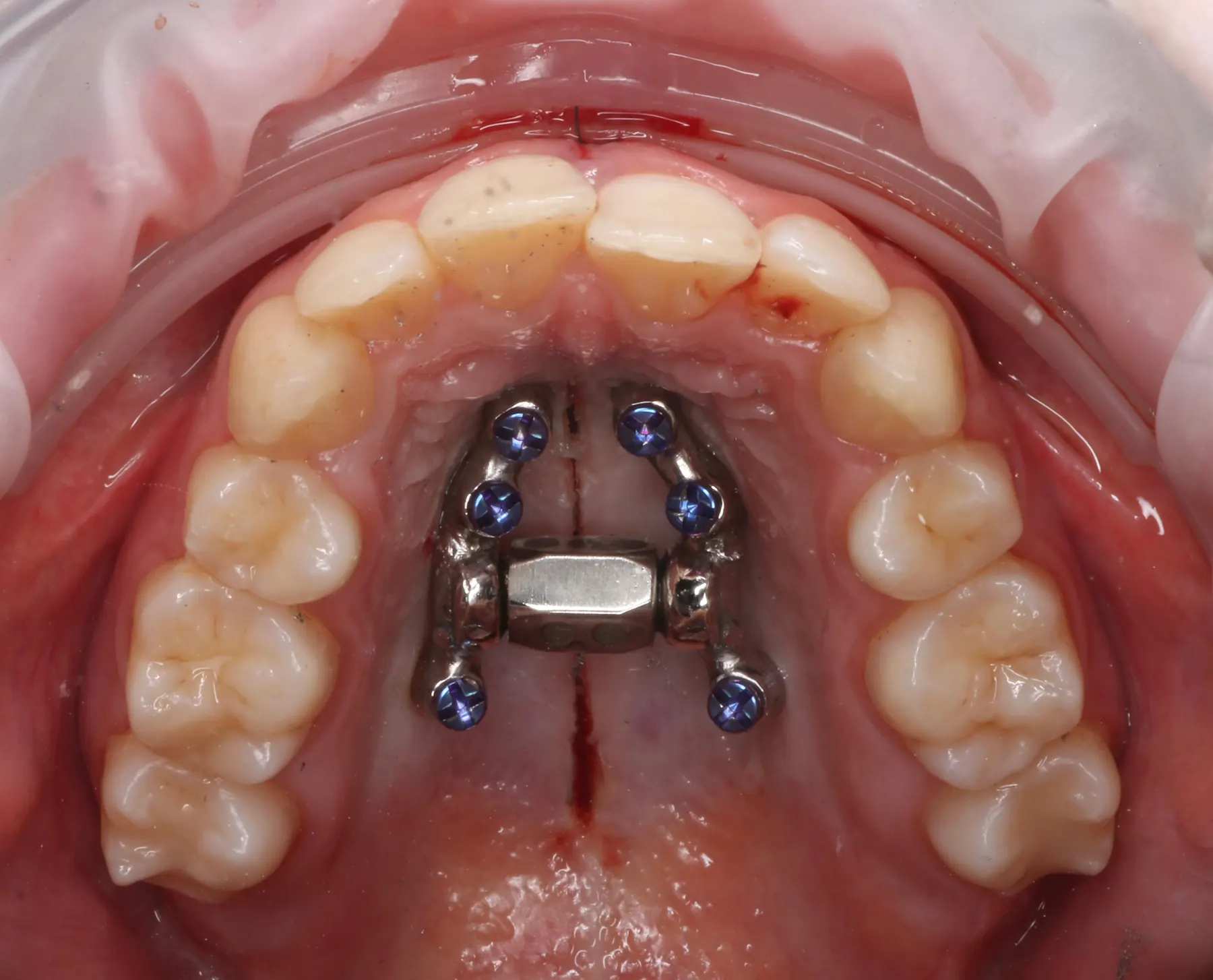Intraoral view of a miniscrew-assisted rapid palatal expander fitted across the palate